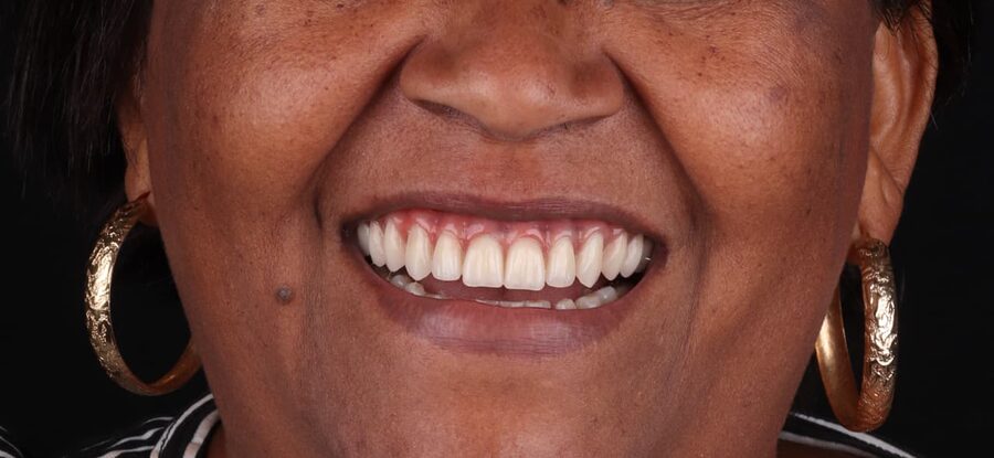 Depois — Harmonização do sorriso